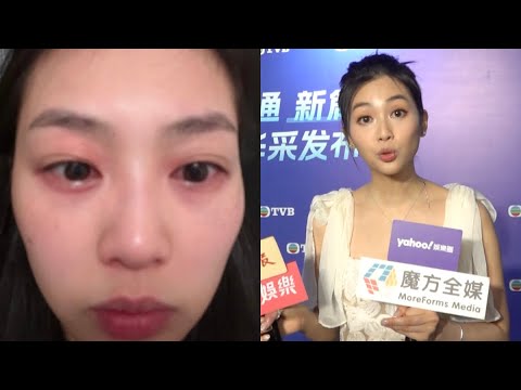 【做訪問如同交代遺言😱】郭柏妍食物過敏導致呼吸困難坦言“驚自己會死” 自爆重要密碼已交晒俾媽咪