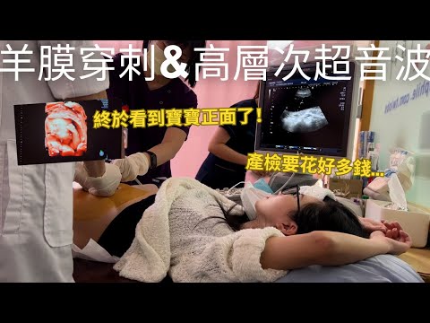 終於看到寶寶正面了😍醫生說腿有長性別已經不可能翻盤🤣產檢自費項目花好多錢😂 | 羊膜穿刺&高層次超音波(有CC字幕)
