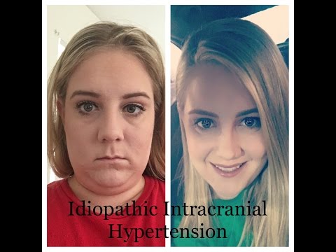Idiopathic Intracranial Hypertension (IIH)