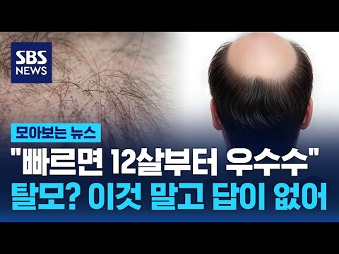 "빠르면 12살부터 우수수 빠진다"…탈모? 이것 말고 답이 없어 / SBS / 모아보는 뉴스