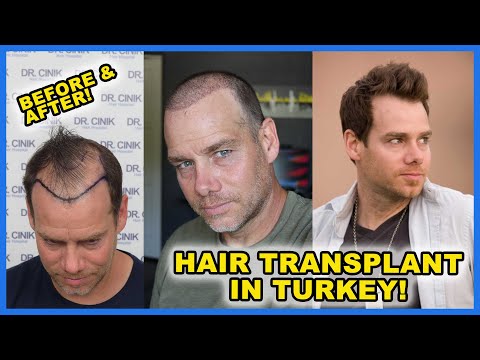 Normal guys gets a HAIR TRANSPLANT in TURKEY! My * Before and After* Hair Transplant Journey!