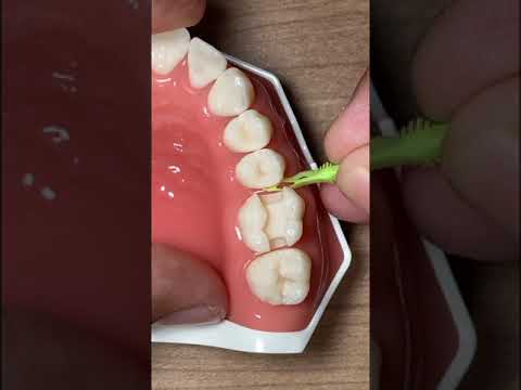 Webinar Live Instagram about first upper molar composite