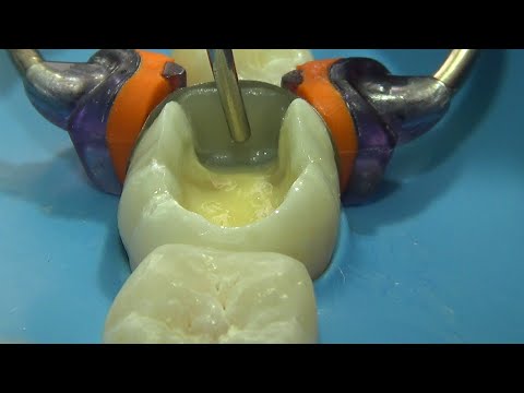 Classe II – técnica incremental com 3 tonalidades (Class II – Layering technique with 3 shades)