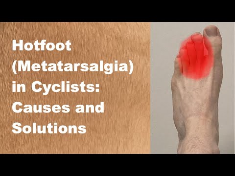 Hotfoot: Metatarsalgia in Cyclists