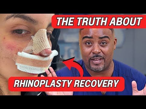 Rhinoplasty Recovery: The Honest Timeline & What to REALLY Expect