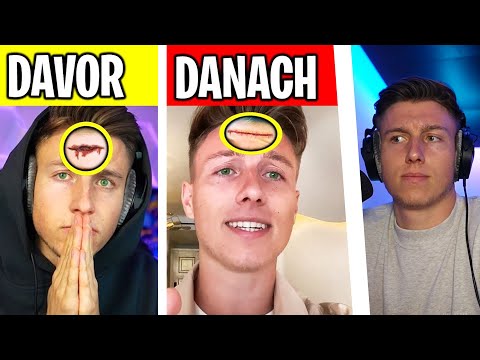 5 YOUTUBER die OPERIERT wurden (iCrimax, Avive,..)