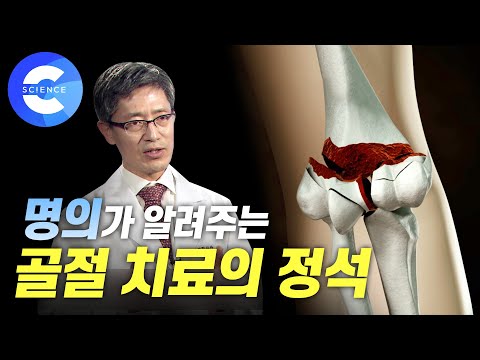 명의가 알려주는 골절 치료