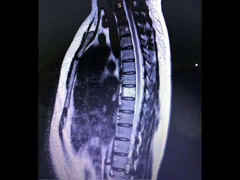 Гемангиома в позвонке: опасно ли это и нужно-ли оперировать?