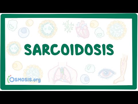 Sarcoidosis - causes, symptoms, diagnosis, treatment, pathology