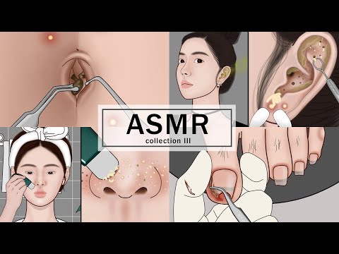 ASMR Body Treatments! Navel Stone, Ingrown Toenail, Ear Cleaning, Blackheads | Meng's Stop Motion