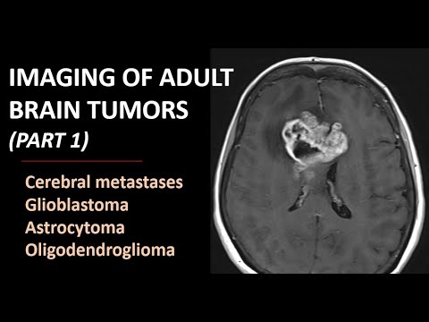 Imaging of brain tumors (part 1): metastases, glioblastoma and beyond...