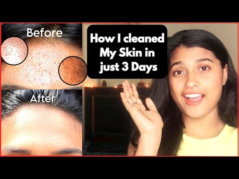 How to remove TINY BUMPS Naturally at home | Get rid of small bumps on Forehead & bumpy skin |