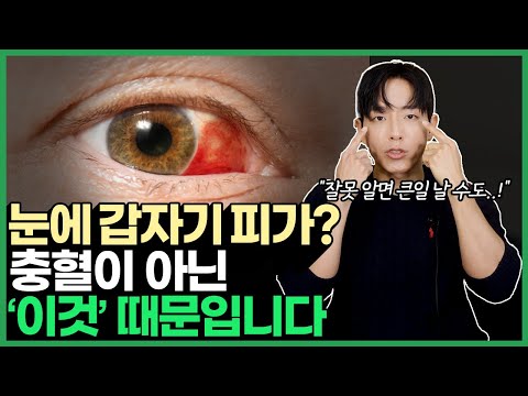 [sub]Eye Redness or Bleeding? | Ophthalmologist Explains Subconjunctival Hemorrhage & Red Eye Causes