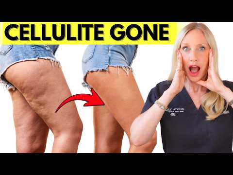 Get Rid of CELLULITE FAST at home Women Over 50
