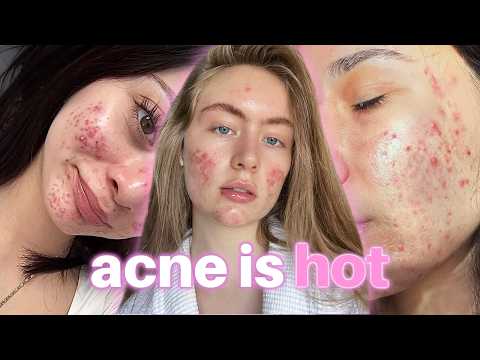 acne doesn’t make you ugly 😱 (the truth no one tells you)