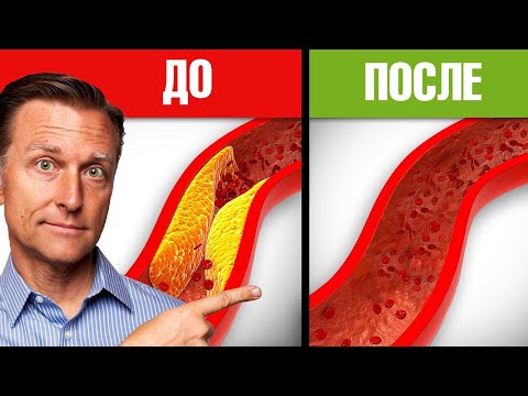 The 5 best nutrients for reducing plaque in arteries. Atherosclerosis.🙌