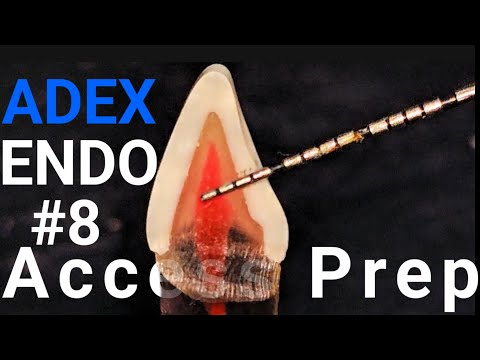 [ADEX] Endo Anterior Tooth Access Prep with CROSS section #CDCA #adex