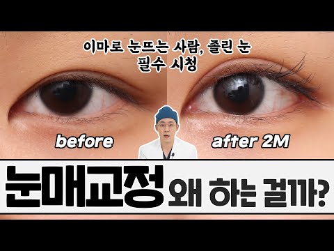 눈매교정이 정확히 뭔지 알려드릴게요!  쌍꺼플하고 다르다는 거 꼭 아셔야 해요!!      #눈매교정 #졸린눈 #안검하수