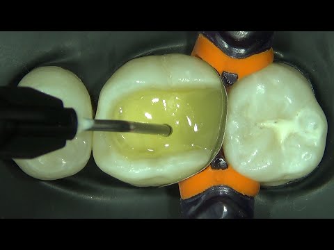 Classe II – Resina Bulk Fluida (Class II - Flowable Bulk Fill Composite)