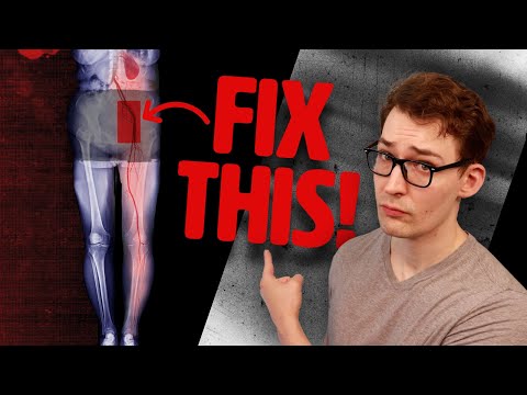 Your Arteries are Diseased - THIS is how you Restore them!