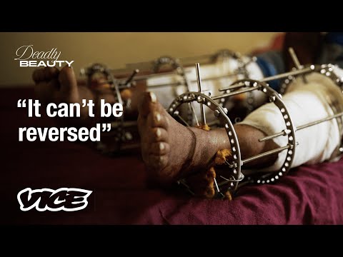 Breaking Bones to Grow Taller in India | Deadly Beauty