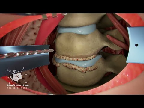شاهد عملية ازالة الغضروف _ lumbar discectomy