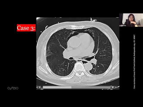 Approach to CT scan of the Acute Abdomen