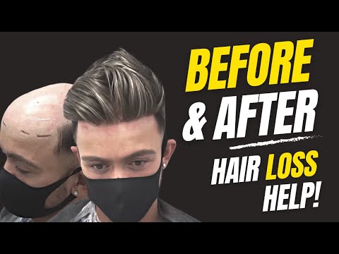 Before & After | Hair System | Non-Surgical Hair Replacement System Men/Women | UK/USA/International