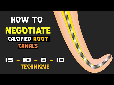 How to negotiate calcified root canals