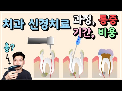 신경치료 과정, 통증, 기간, 비용, 단계, 마취, 염증, 크라운 다 알려드립니다ㅣ근관치료