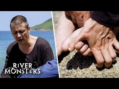Meet The Man Who Has A Toe On His Hand Instead Of A Thumb | River Monsters