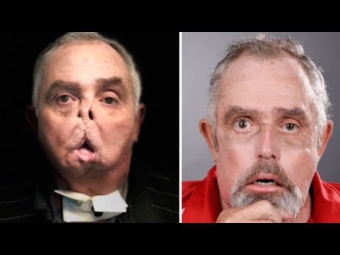 Man risks his life to undergo Canada's first face transplant