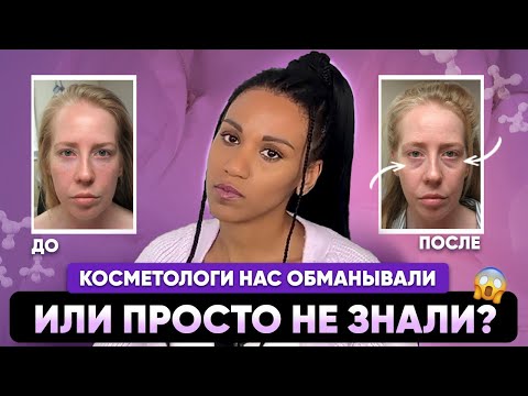 НОСОСЛЁЗНЫЕ БОРОЗДЫ - впадины под глазами: новые открытия анатомии, отсроченные осложнения 💉
