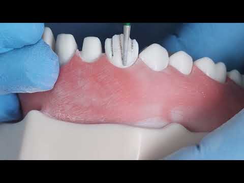 تحضير ناب علوي لاستقبال تاج زيركون