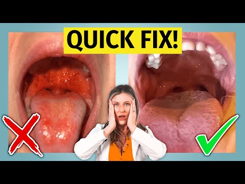 Strep Throat - treat it fast (learn how)