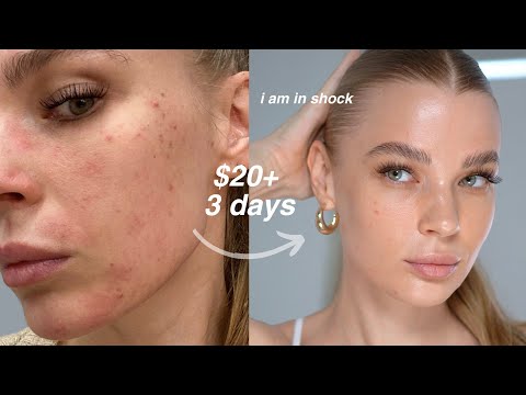 how i accidentally healed my skin barrier in 3 days