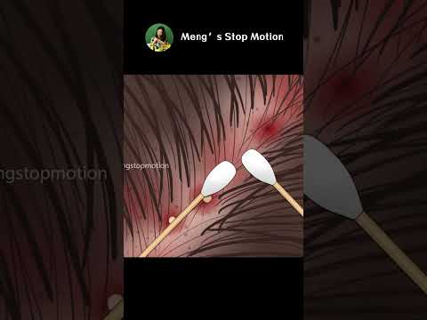 ASMR Itchy scalp and head acne? Stress-relieving scalp treatment