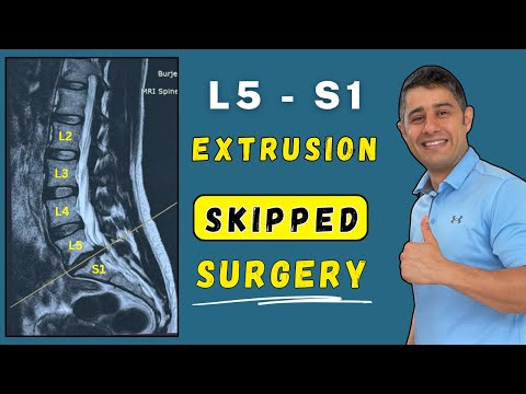 Lumbar disc extrusion L5 S1 recovery without surgery.