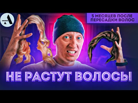 Пересадка волос спустя 5 месяцев после операции! ВСЯ ПРАВДА о пересадке без цензуры!