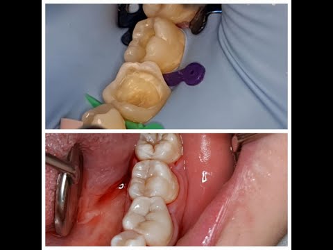 بناء التشريح للكومبوزيت للسطح الطاحن لرحى سفلية anatomy by composite for lower molar