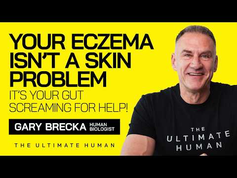 Why Your Eczema Isn’t Just Skin Deep...Here’s the REAL Cause! | TUH #176
