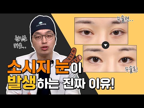 소시지눈, 왜 생기는 걸까? 소세지눈 재수술 전 필수 시청 ✔️ 원인, 해결방법, 재수술전 주의할 점까지!