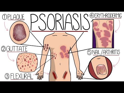Psoriasis Explained Clearly - Including Types and Treatment