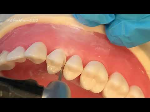 REST 528 - PFM Crown Prep #12