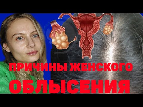 Женское облысение. Как определить причины. Виды андрогенной алопеции. Лечение.
