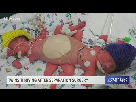 Twins thriving 5 years after separation surgery at Driscoll Children's Hospital