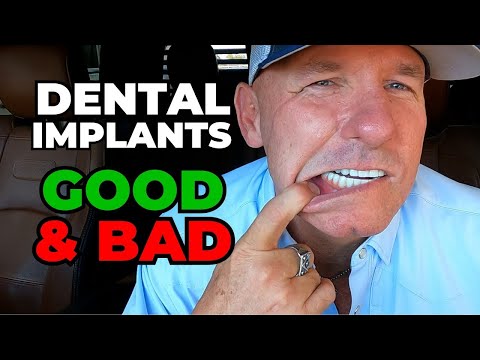 The GOOD and BAD Of My Dental Implants After 2 Years