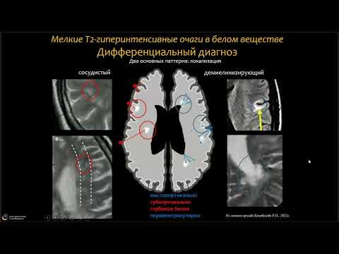 Вебинар МРО РОРР: "Дифференциальная МРТ диагностика при рассеянном склерозе"