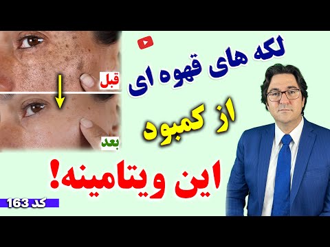 درمان تضمینی لکه‌ های قهوه ای و لکه های پیری پوست دست و صورت بدون دارو و لیزر با این روش معجزه آسا!