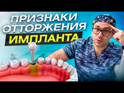 Признаки отторжения импланта - как распознать и что делать
